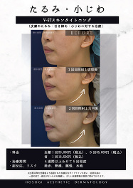 V-STスキンタイトニング