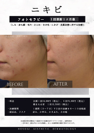 フォトセラピー