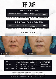 ピーリング＆CO2